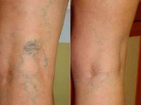 Damar Çekilmesi Belirtileri ve Tedavisi