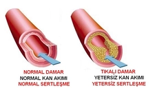 Damar Tıkanıklığı Belirtileri ve Tedavisi