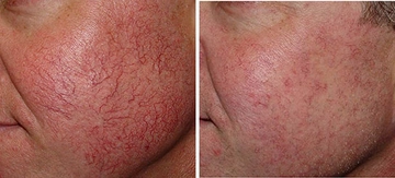 Kılcal Damar Özellikleri ve Faydaları Nelerdir?