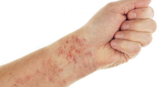 kolda damar sertliği belirtileri